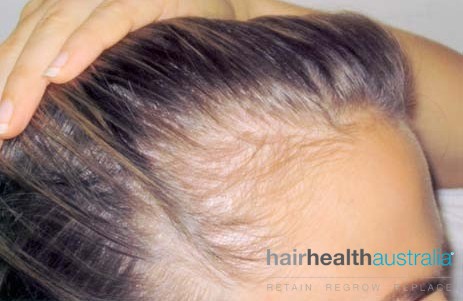 Hair Loss Treatment – Females - Hair Health Australia
