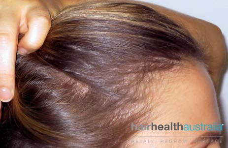Hair Loss Treatment – Females - Hair Health Australia