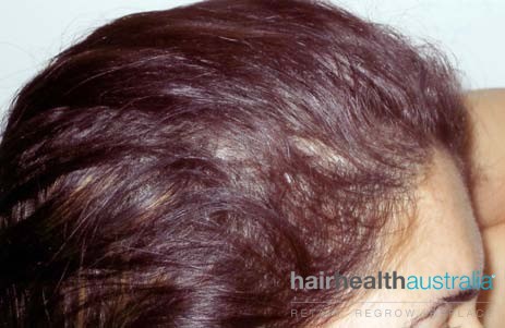 NaturalGROWTH Results - Female - Hair Health Australia