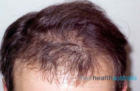Hair Loss Treatment – male - Hair Health Australia