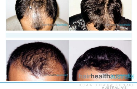 Hair Loss Clinic Surry Hills Sydney NSW Hair Health Australia 575 Elizabeth St Surry Hills NSW 2016 (02) 9319 0051 http://www.hairhealthaustralia.com.au